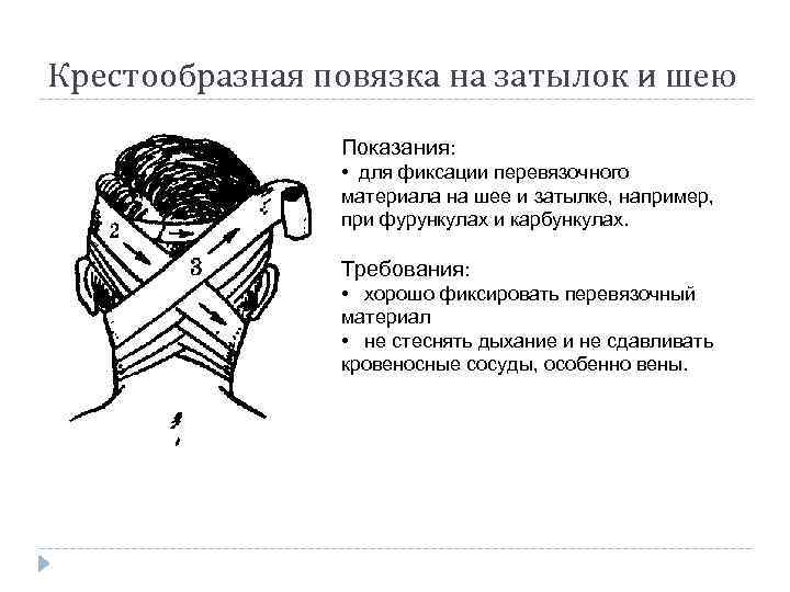 Крестообразная повязка на затылок и шею Показания: • для фиксации перевязочного материала на шее