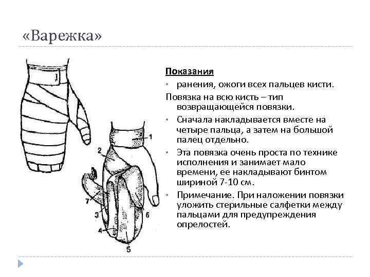  «Варежка» Показания • ранения, ожоги всех пальцев кисти. Повязка на всю кисть –