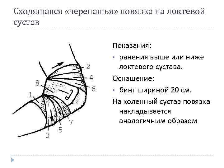 Сходящаяся «черепашья» повязка на локтевой сустав Показания: • ранения выше или ниже локтевого сустава.