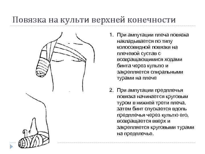 Повязка на культи верхней конечности 1. При ампутации плеча повязка накладывается по типу колосовидной