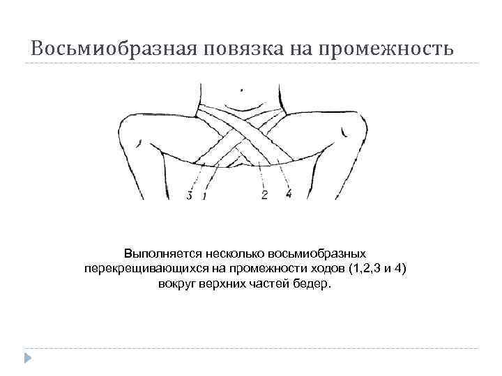 Восьмиобразная повязка на промежность Выполняется несколько восьмиобразных перекрещивающихся на промежности ходов (1, 2, 3