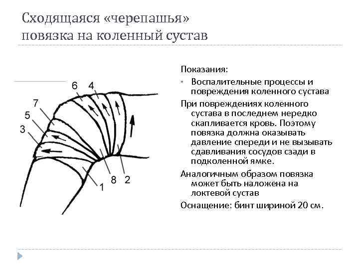 Сходящаяся «черепашья» повязка на коленный сустав Показания: • Воспалительные процессы и повреждения коленного сустава