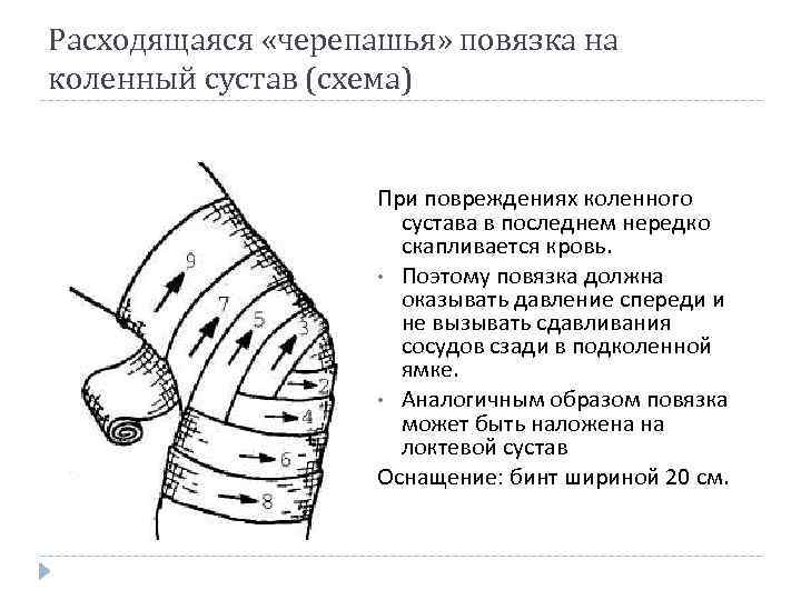 Расходящаяся «черепашья» повязка на коленный сустав (схема) При повреждениях коленного сустава в последнем нередко