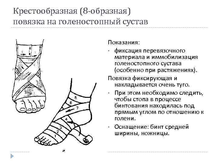 Крестообразная (8 -образная) повязка на голеностопный сустав Показания: • фиксация перевязочного материала и иммобилизация