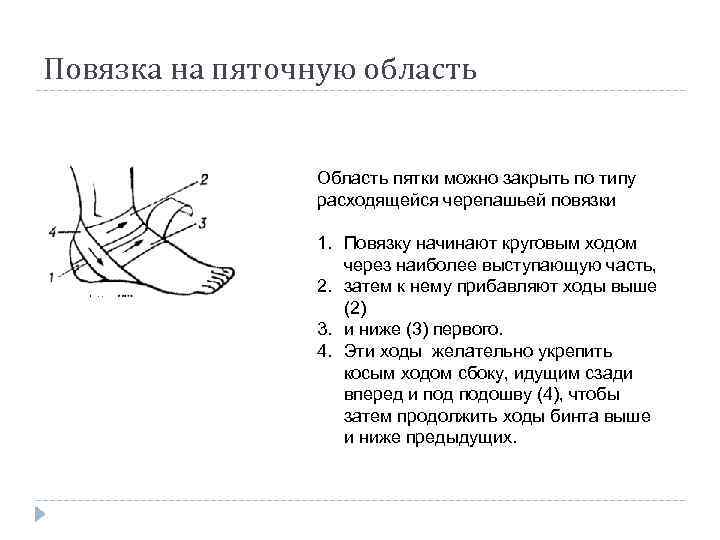 Повязка на пяточную область Область пятки можно закрыть по типу расходящейся черепашьей повязки 1.