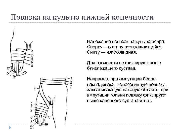 Повязка на культю нижней конечности Наложение повязок на культю бедра: Сверху —по типу возвращающейся,