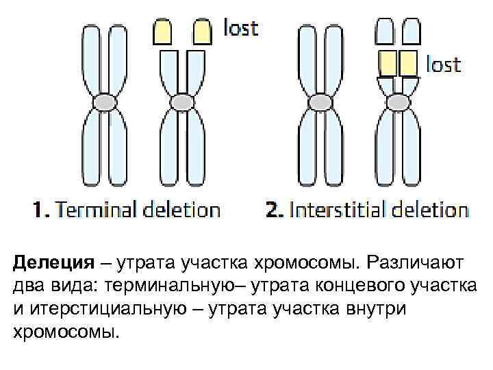 Делеция – утрата участка хромосомы. Различают два вида: терминальную– утрата концевого участка и итерстициальную