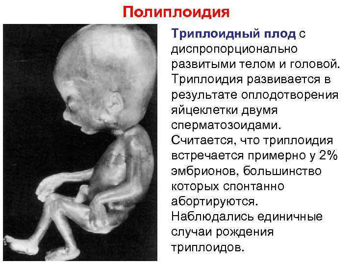 Полиплоидия Tриплоидный плод с диспропорционально развитыми телом и головой. Триплоидия развивается в результате оплодотворения