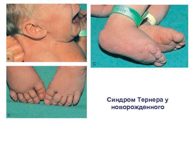 Синдром Тернера у новорожденного 