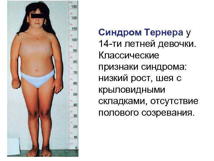 Синдром Тернера у 14 -ти летней девочки. Классические признаки синдрома: низкий рост, шея с