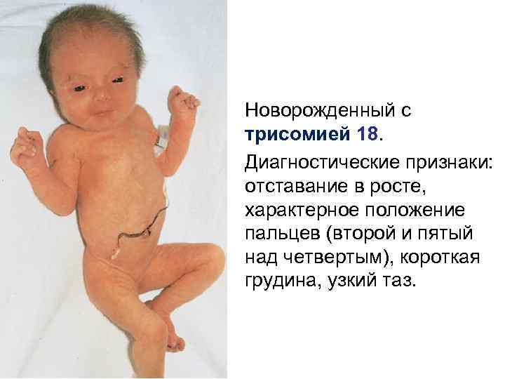 Новорожденный с трисомией 18. Диагностические признаки: отставание в росте, характерное положение пальцев (второй и