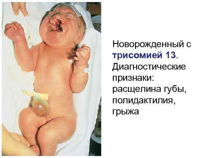 Новорожденный с трисомией 13. Диагностические признаки: расщелина губы, полидактилия, грыжа 