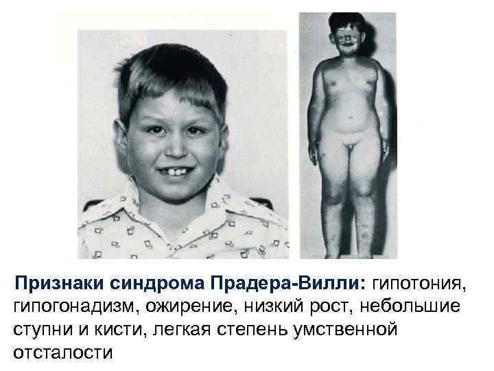 Признаки синдрома Прадера-Вилли: гипотония, гипогонадизм, ожирение, низкий рост, небольшие ступни и кисти, легкая степень