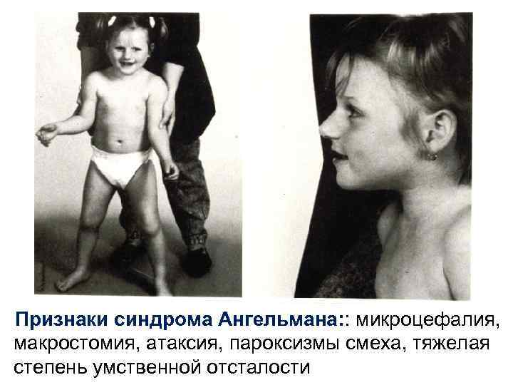 Признаки синдрома Ангельмана: : микроцефалия, макростомия, атаксия, пароксизмы смеха, тяжелая степень умственной отсталости 