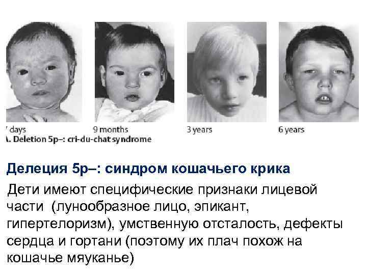 Делеция 5 p–: синдром кошачьего крика Дети имеют специфические признаки лицевой части (лунообразное лицо,