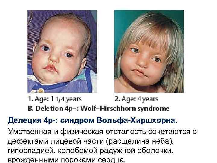 Делеция 4 р-: синдром Вольфа-Хиршхорна. Умственная и физическая отсталость сочетаются с дефектами лицевой части