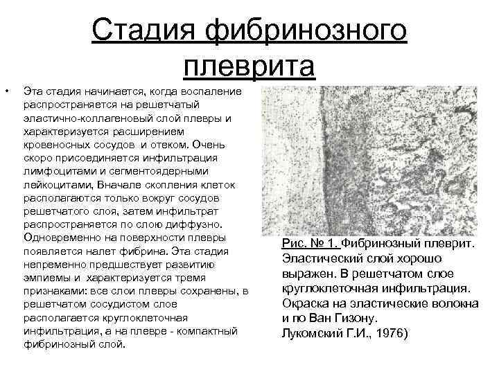 Стадия фибринозного плеврита • Эта стадия начинается, когда воспаление распространяется на решетчатый эластично коллагеновый
