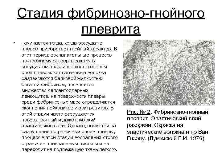 Стадия фибринозно гнойного плеврита • начинается тогда, когда экссудат в плевре приобретает гнойный характер.