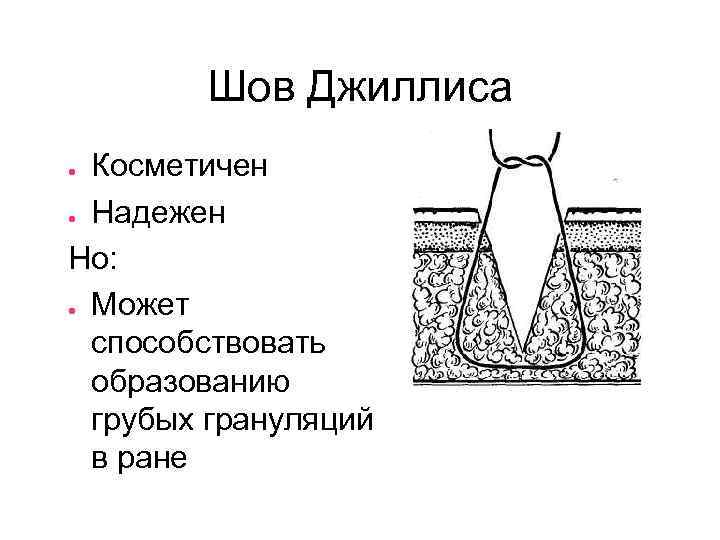Шов Джиллиса Косметичен ● Надежен Но: ● Может способствовать образованию грубых грануляций в ране