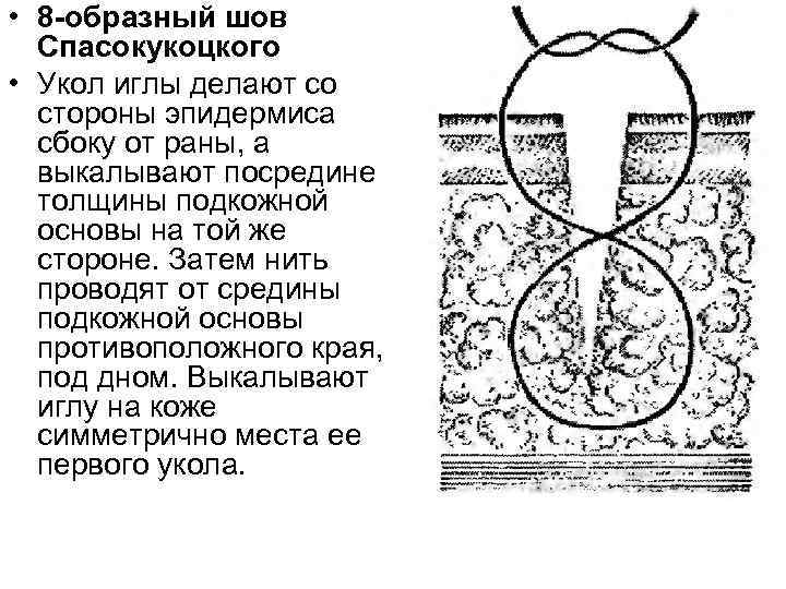  • 8 -образный шов Спасокукоцкого • Укол иглы делают со стороны эпидермиса сбоку