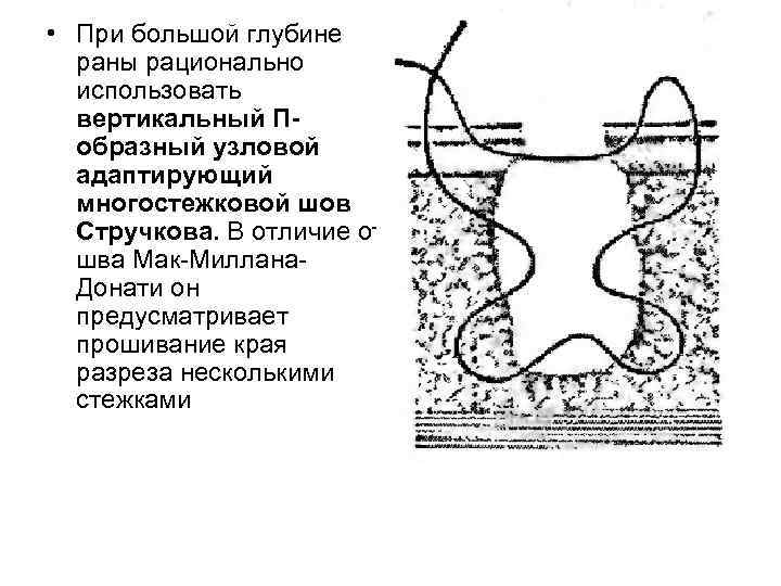  • При большой глубине раны рационально использовать вертикальный Побразный узловой адаптирующий многостежковой шов