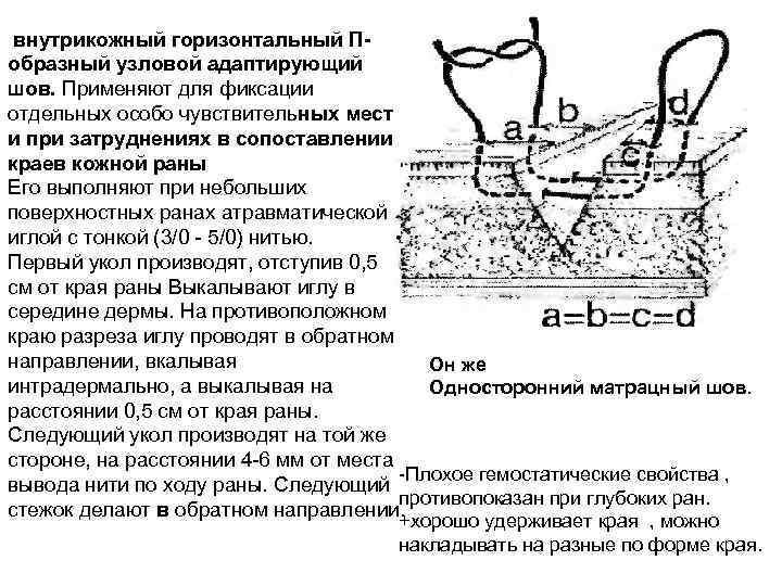  внутрикожный горизонтальный Побразный узловой адаптирующий шов. Применяют для фиксации отдельных особо чувствительных мест