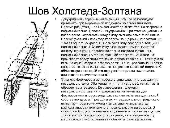 Шов Холстеда-Золтана • • - двухрядный непрерывный съемный шов Его рекомендуют применять при выраженной