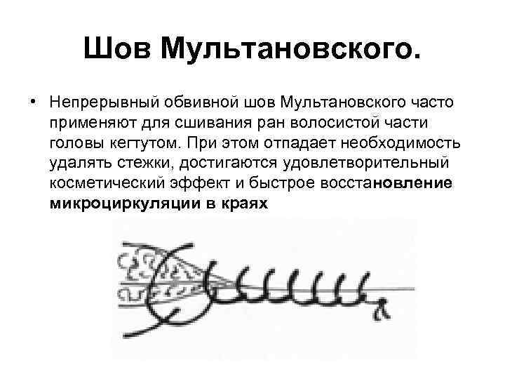 Шов Мультановского. • Непрерывный обвивной шов Мультановского часто применяют для сшивания ран волосистой части