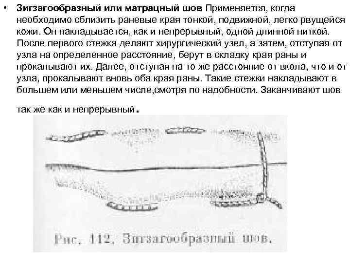  • Зигзагообразный или матрацный шов Применяется, когда необходимо сблизить раневые края тонкой, подвижной,