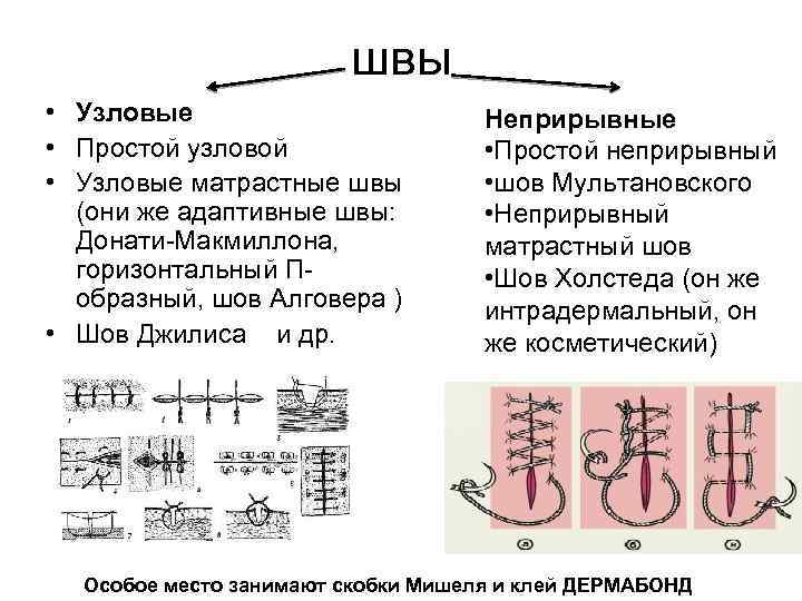 швы • Узловые • Простой узловой • Узловые матрастные швы (они же адаптивные швы: