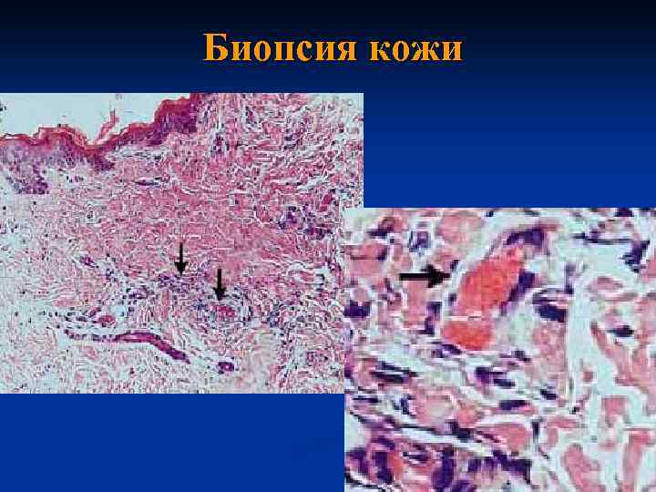  Биопсия кожи 