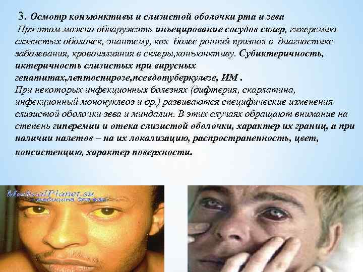  3. Осмотр конъюнктивы и слизистой оболочки рта и зева При этом можно обнаружить