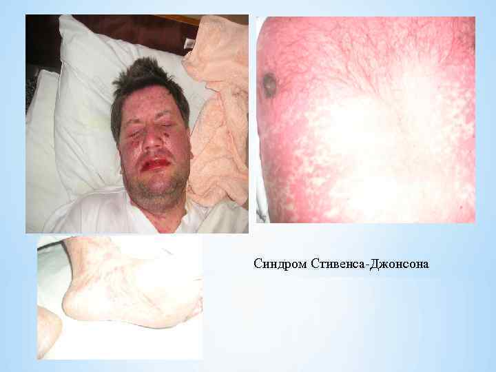 Синдром Стивенса Джонсона 