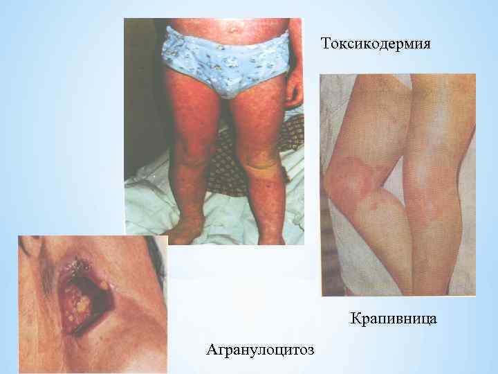 Токсикодермия Крапивница Агранулоцитоз 