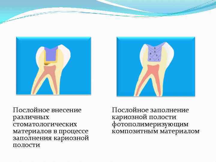 Послойное внесение различных стоматологических материалов в процессе заполнения кариозной полости Послойное заполнение кариозной полости