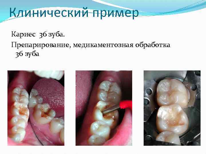 Клинический пример Кариес 36 зуба. Препарирование, медикаментозная обработка 36 зуба 