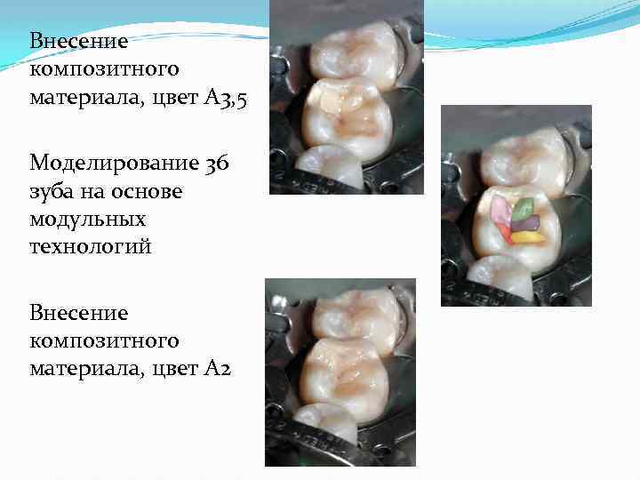 Внесение композитного материала, цвет А 3, 5 Моделирование 36 зуба на основе модульных технологий