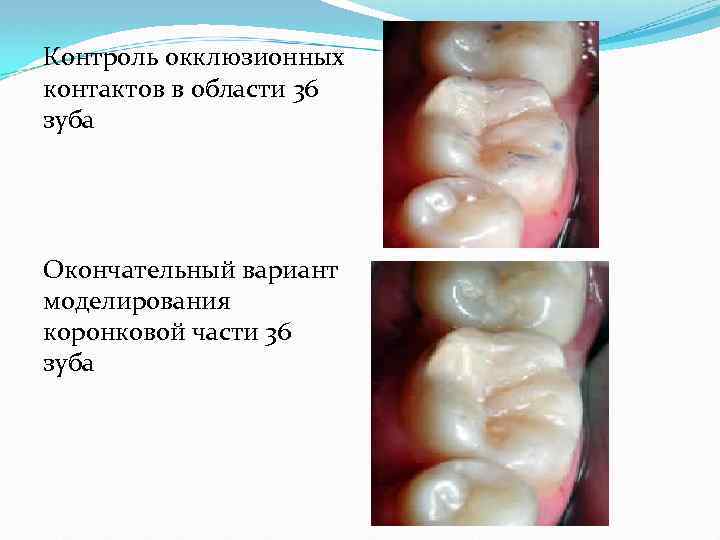 Контроль окклюзионных контактов в области 36 зуба Окончательный вариант моделирования коронковой части 36 зуба