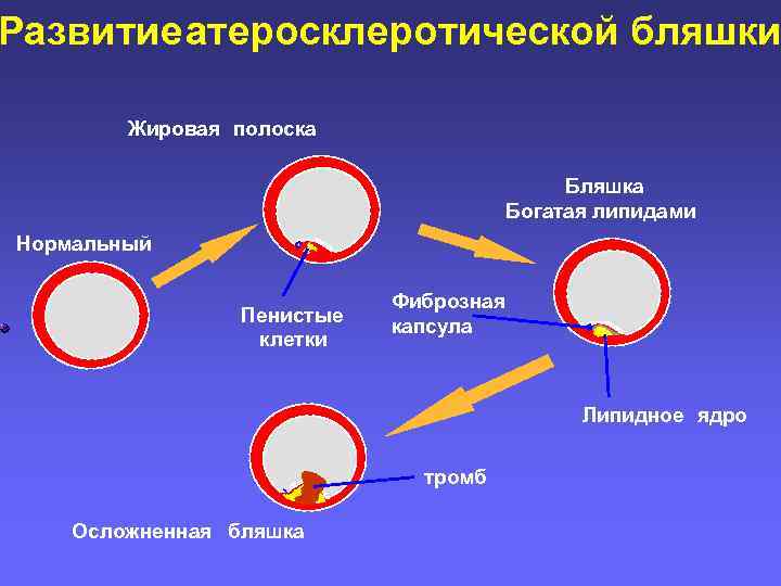 Развитие атеросклеротической бляшки Жировая полоска Бляшка Богатая липидами Нормальный Пенистые клетки Фиброзная капсула Липидное