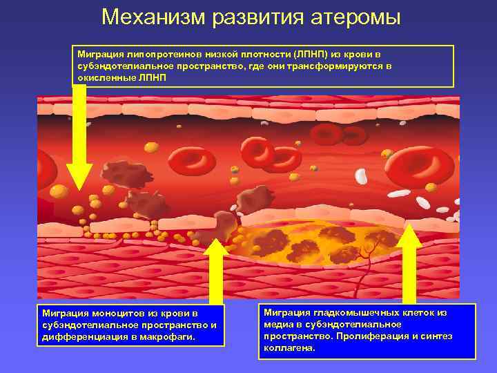  Механизм развития атеромы Миграция липопротеинов низкой плотности (ЛПНП) из крови в субэндотелиальное пространство,