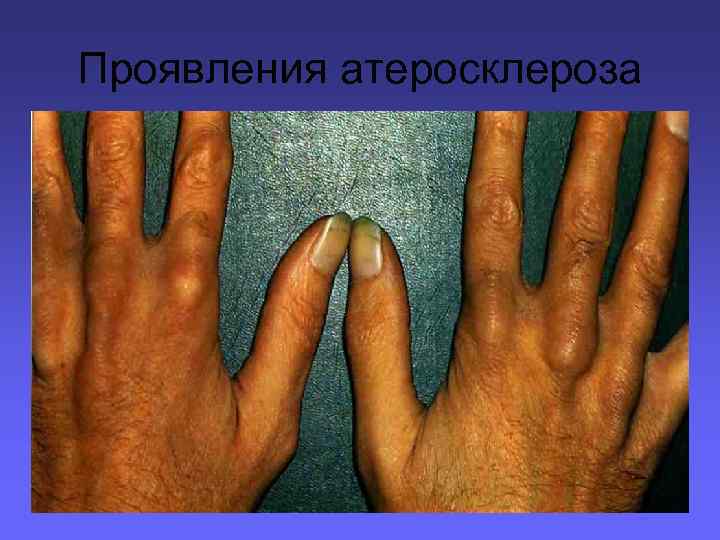 Проявления атеросклероза 