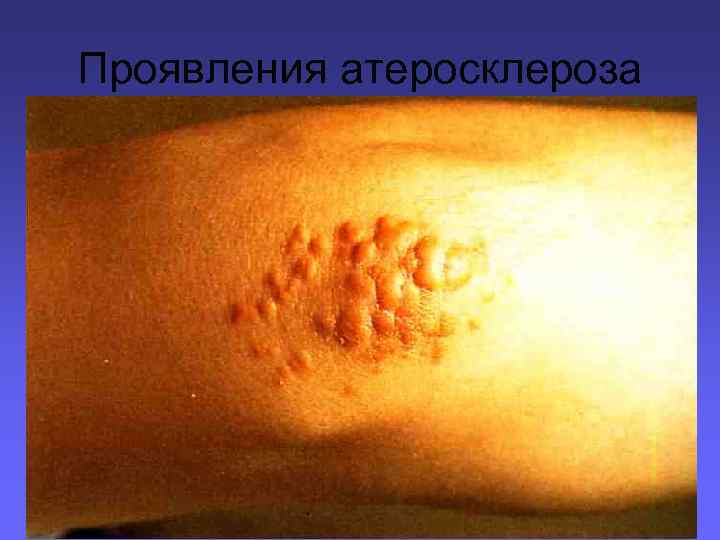 Проявления атеросклероза 