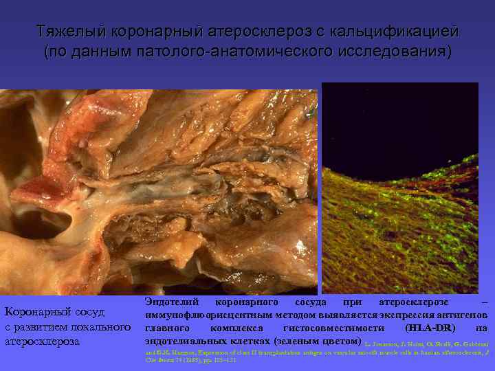 Тяжелый коронарный атеросклероз с кальцификацией (по данным патолого-анатомического исследования) Коронарный сосуд с развитием локального