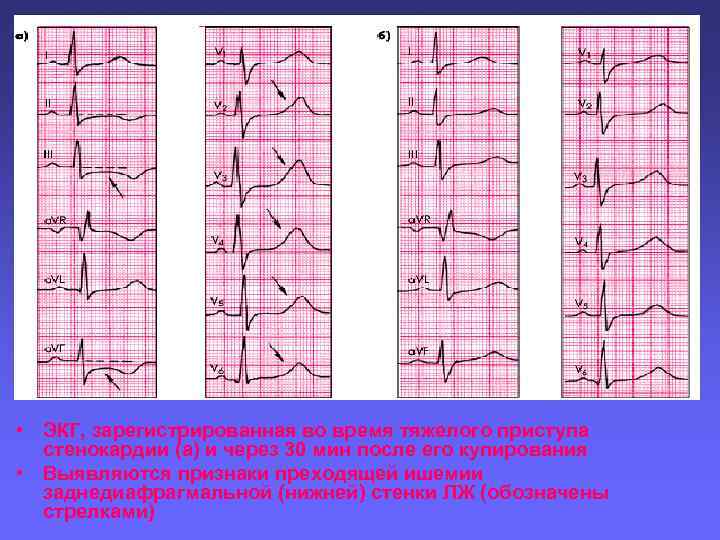  • ЭКГ, зарегистрированная во время тяжелого приступа стенокардии (а) и через 30 мин
