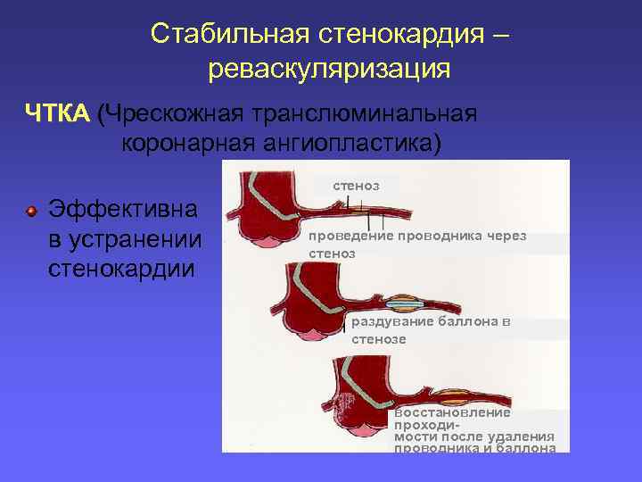 Стабильная стенокардия – реваскуляризация ЧТКА (Чрескожная транслюминальная коронарная ангиопластика) стеноз Эффективна в устранении стенокардии