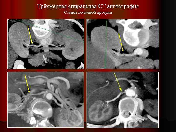 Трёхмерная спиральная CT ангиография Стеноз почечной артерии 