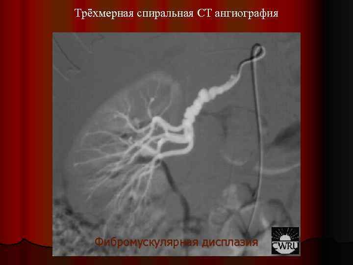 Трёхмерная спиральная CT ангиография Фибромускулярная дисплазия 