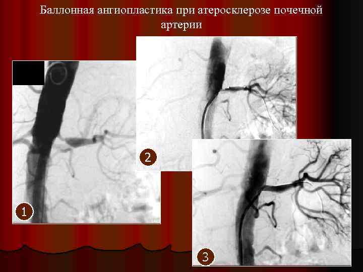 Баллонная ангиопластика при атеросклерозе почечной артерии 2 1 3 