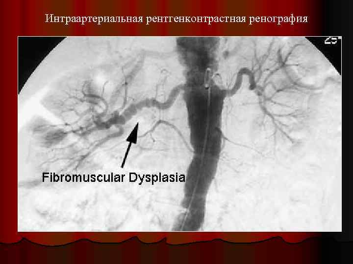 Интраартериальная рентгенконтрастная ренография 