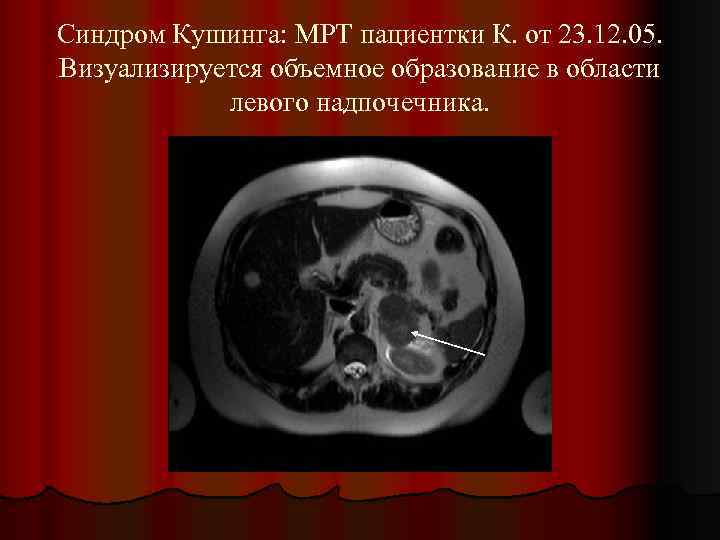 Синдром Кушинга: МРТ пациентки К. от 23. 12. 05. Визуализируется объемное образование в области